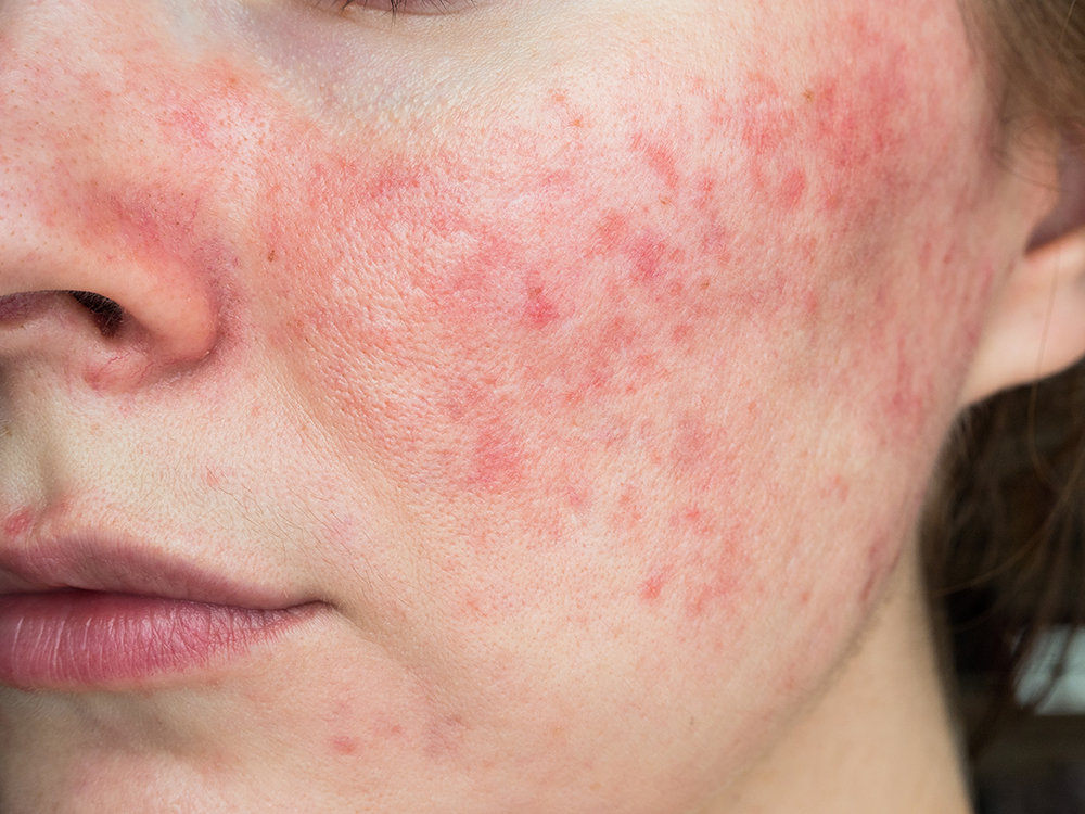 rosacea